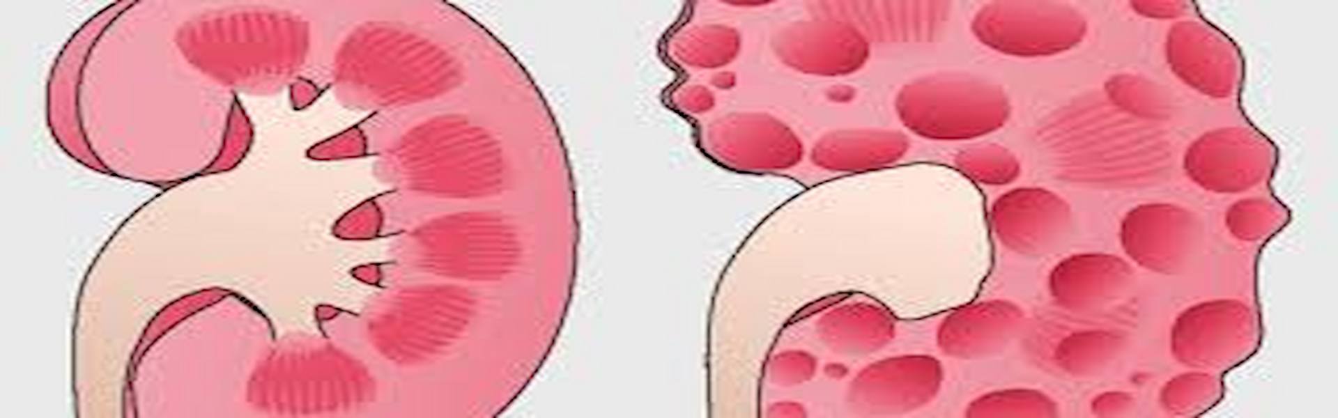 polycystic kidney disease (3)