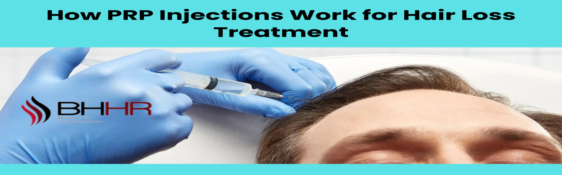 prp injections for hair loss (1)