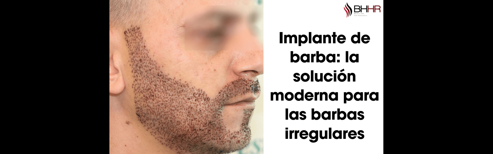 implante barba (1)